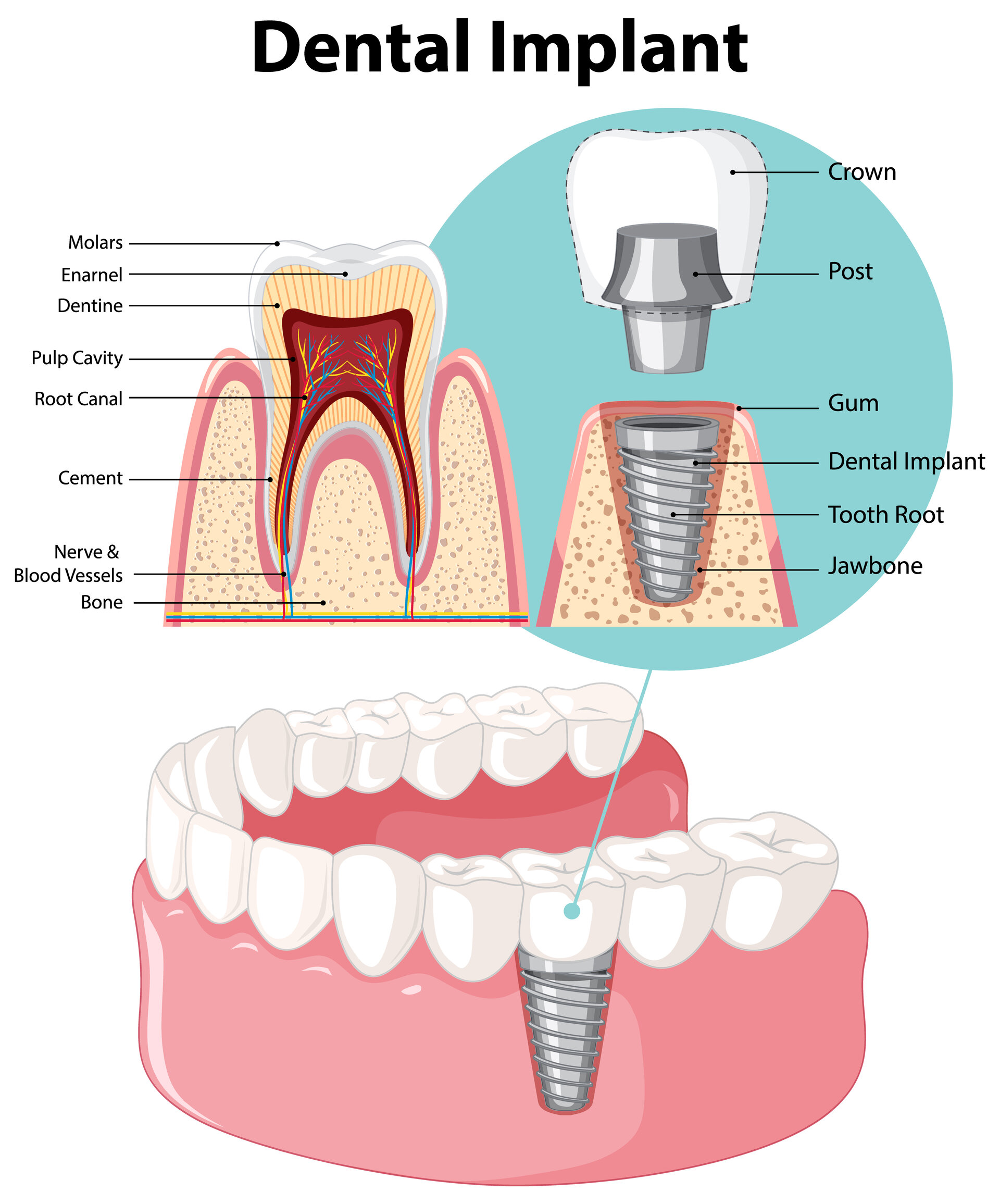 You are currently viewing Implants and Crowns in Abuja: Restoring Smiles