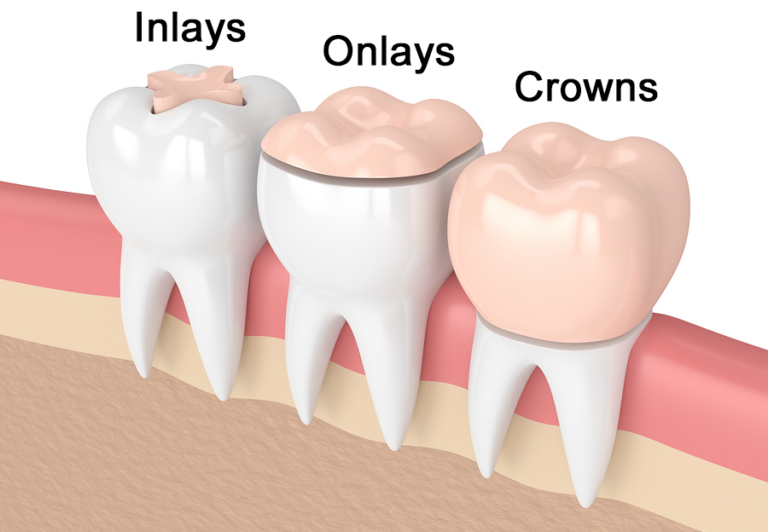 Read more about the article Enhance Your Smile with Dental Inlays and Onlays