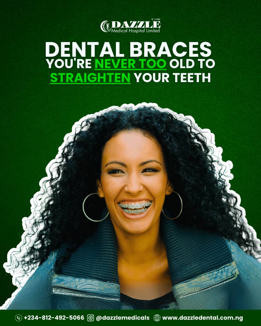 You are currently viewing Affordable Braces in Abuja: Transform Your Smile with Confidence